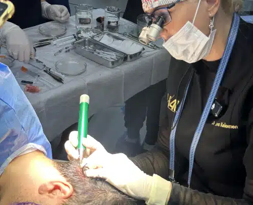 NO Shave FUE demonstration by Dr Kelemen