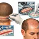 FUT Hair transplant