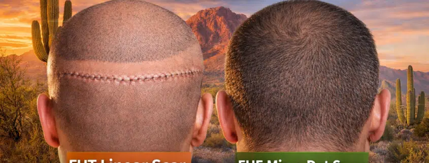 FUT vs FUE scaring