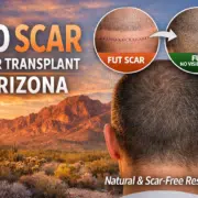 noscarhairtransplant - Hair 4 Life Medical No Scar Hair Transplant Arizona myth